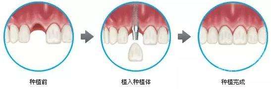 门牙缺失影响形象如何修复呢